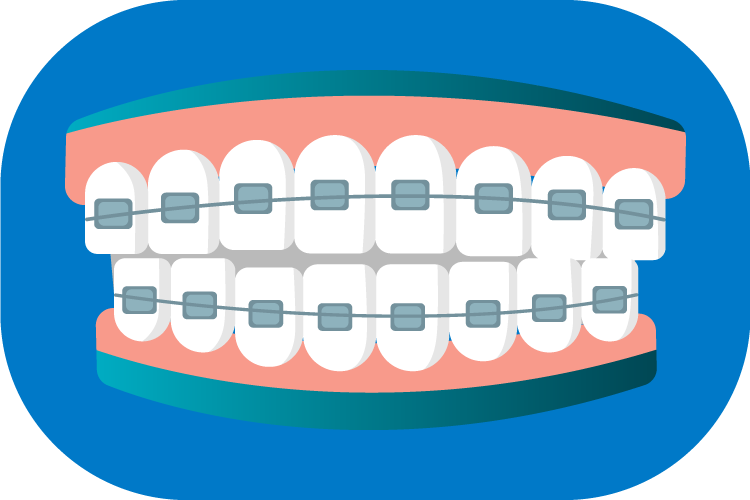 dientes con brackets ortodoncia tradicional integramédica